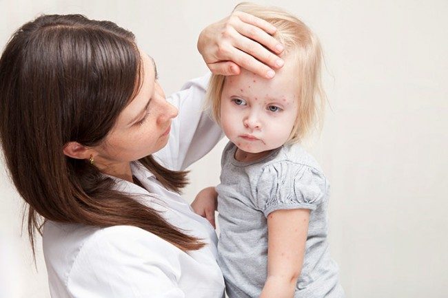 Symptoms and Treatment of Measles