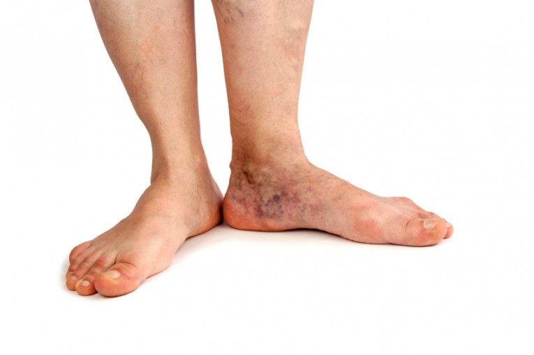 5 Home Remedies to get rid of Varicose Veins