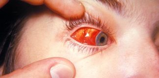Conjunctivitis – Types and symptoms