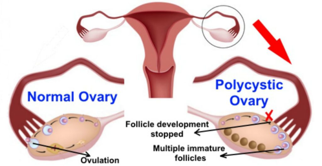 Pictorial Representation of Polycystic Ovaries