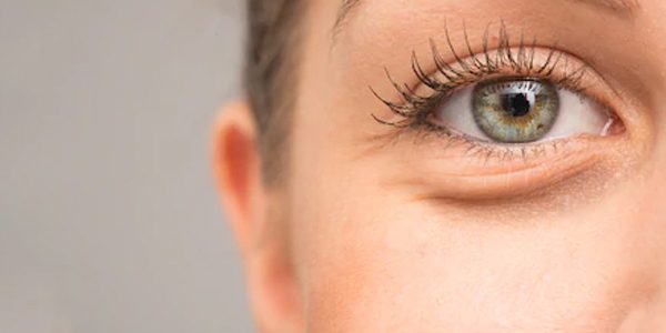 Causes of Under-Eye Bags