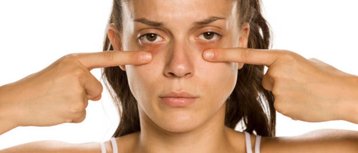 Everything You Need to Know about Dark Circles under Eyes