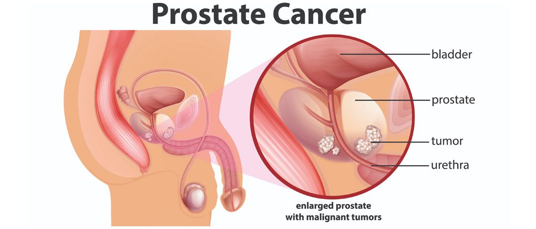 Benefits of Theranostics in Treating Prostate Cancer