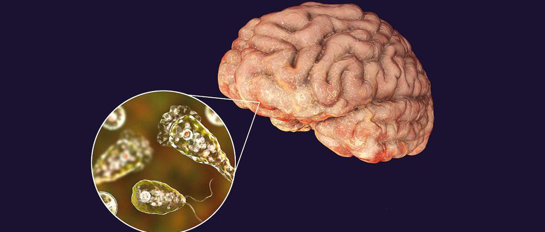 Brain Eating Amoeba Infection Rises In The U.s.