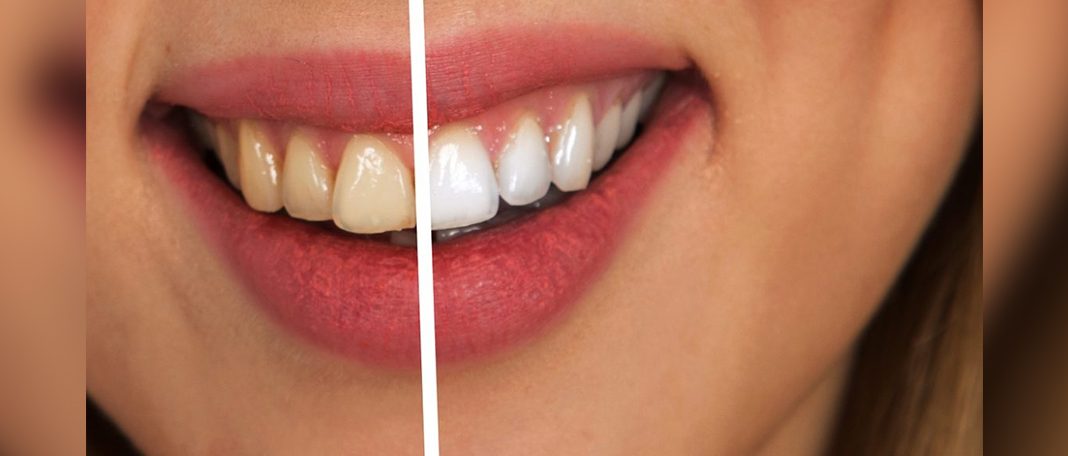 Simple Tricks For Keeping Your Smile White & Healthy