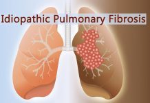 All You Need To Know About Idiopathic Pulmonary Fibrosis
