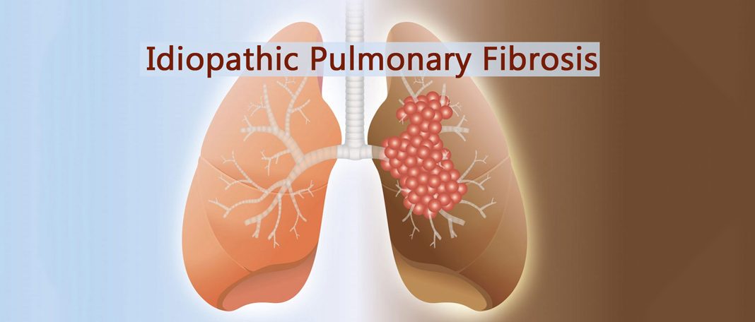 All You Need To Know About Idiopathic Pulmonary Fibrosis