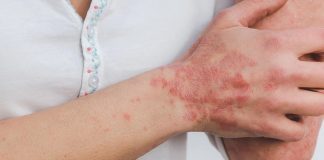 Everything About Causes, Treatment, And Symptoms Of Eczema