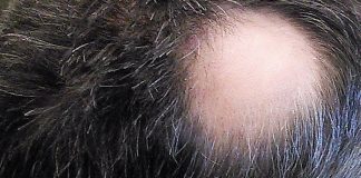 Alopecia Areata: Causes, Symptoms And Treatment