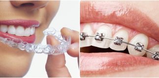 What Works Better – Aligners Or Braces?