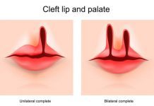 Types of Clefts
