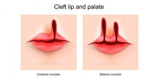 Types of Clefts