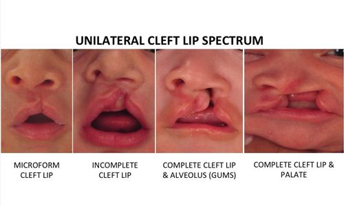 Unilateral Cleft Lip 