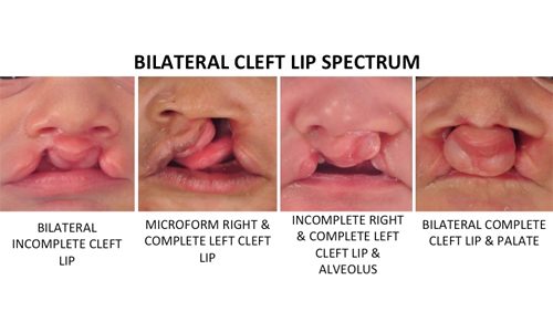 Bilateral Cleft Lip 