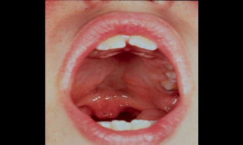Submucous Cleft Palate