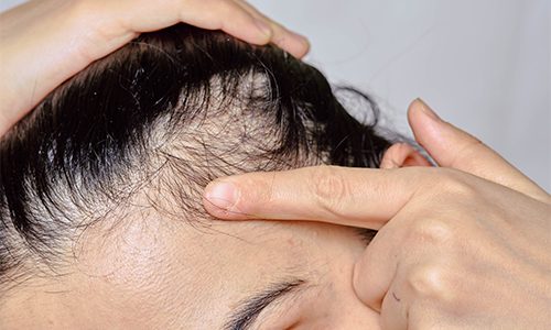 Easiest Solution for Alopecia 